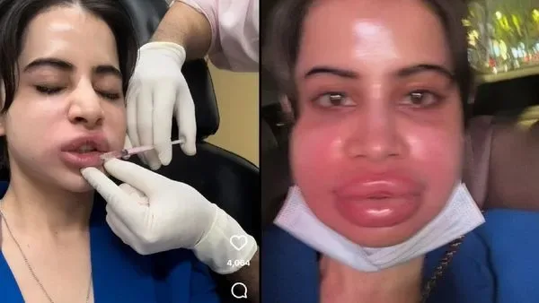 Urfi Javed dissolves lip fillers as part of a shift toward natural beauty.